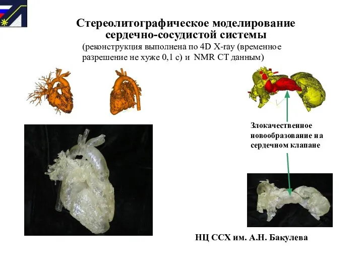 Стереолитографическое моделирование сердечно-сосудистой системы НЦ ССХ им. А.Н. Бакулева Злокачественное новообразование