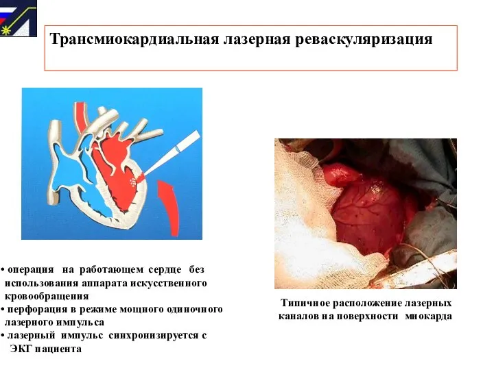 Трансмиокардиальная лазерная реваскуляризация операция на работающем сердце без использования аппарата искусственного