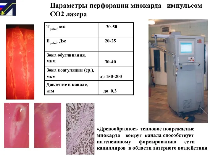 Параметры перфорации миокарда импульсом СО2 лазера «Древообразное» тепловое повреждение миокарда вокруг