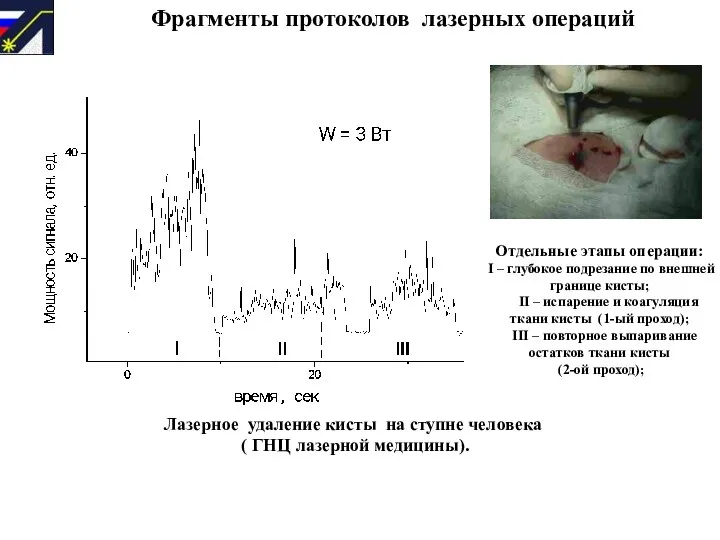 Фрагменты протоколов лазерных операций Отдельные этапы операции: I – глубокое подрезание