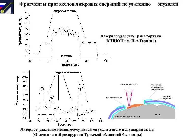 Фрагменты протоколов лазерных операций по удалению опухолей Лазерное удаление рака гортани