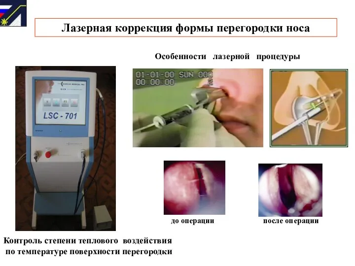 Лазерная коррекция формы перегородки носа ИНТЕЛЛЕКТУАЛЬНЫЕ ЛАЗЕРНЫЕ СИСТЕМЫ Особенности лазерной процедуры