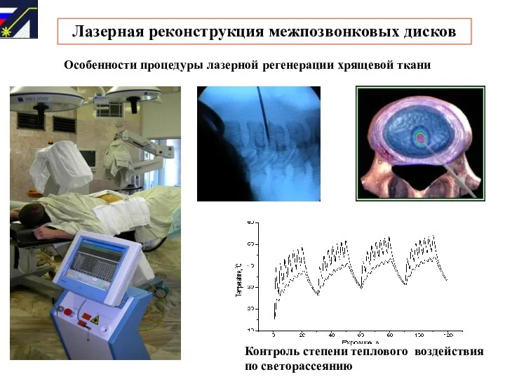 Лазерная реконструкция межпозвонковых дисков ИНТЕЛЛЕКТУАЛЬНЫЕ ЛАЗЕРНЫЕ СИСТЕМЫ Контроль степени теплового воздействия