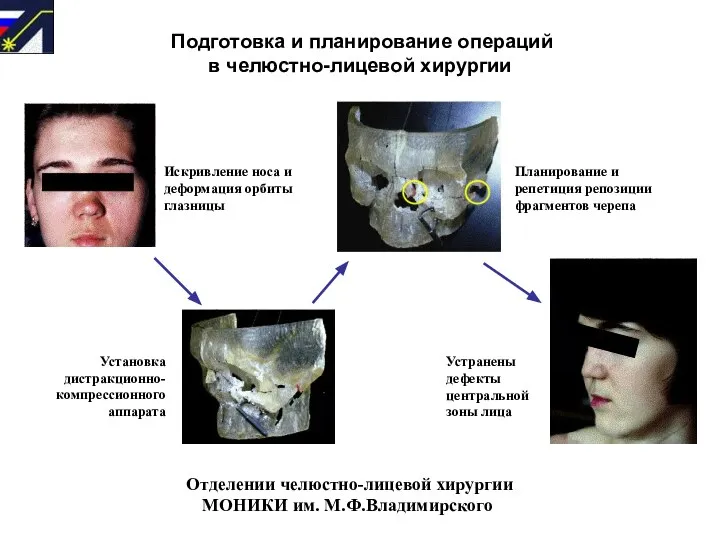 Искривление носа и деформация орбиты глазницы Установка дистракционно- компрессионного аппарата Планирование