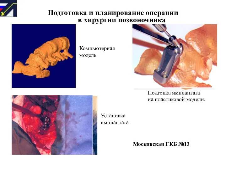 Компьютерная модель Московская ГКБ №13 Подготовка и планирование операции в хирургии