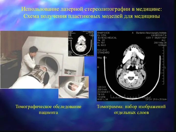 Использование лазерной стереолитографии в медицине: Схема получения пластиковых моделей для медицины