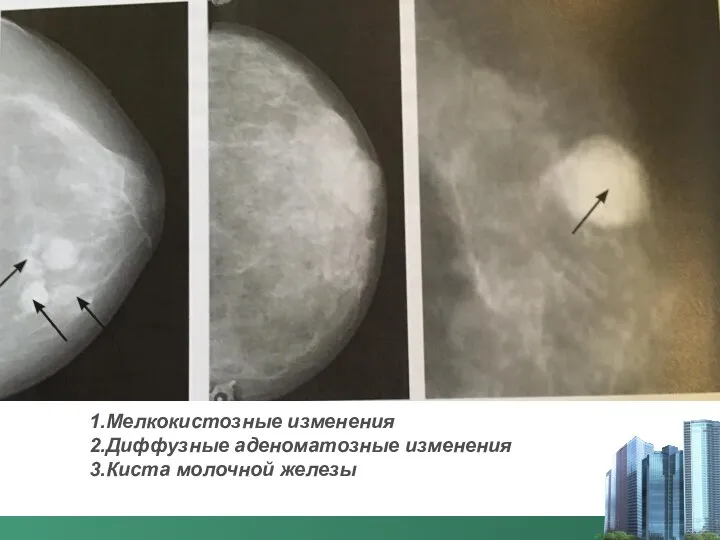 1.Мелкокистозные изменения 2.Диффузные аденоматозные изменения 3.Киста молочной железы