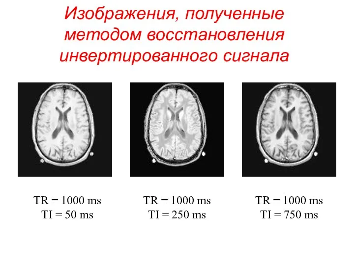 Изображения, полученные методом восстановления инвертированного сигнала TR = 1000 ms TI