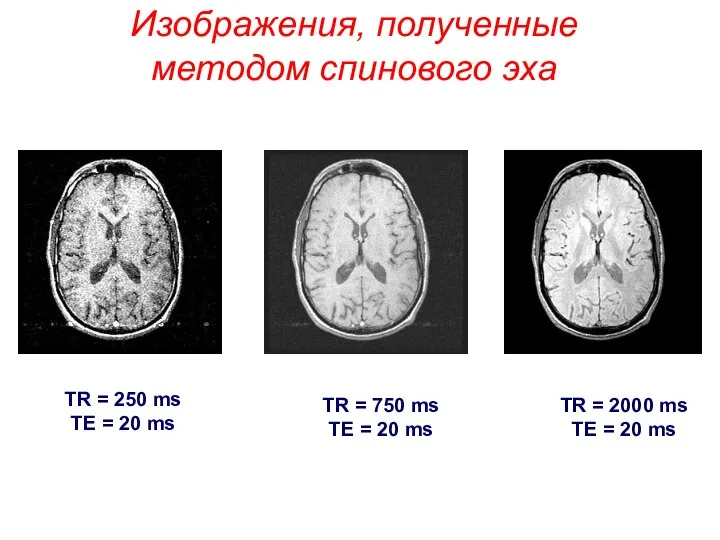 Изображения, полученные методом спинового эха TR = 250 ms TE =