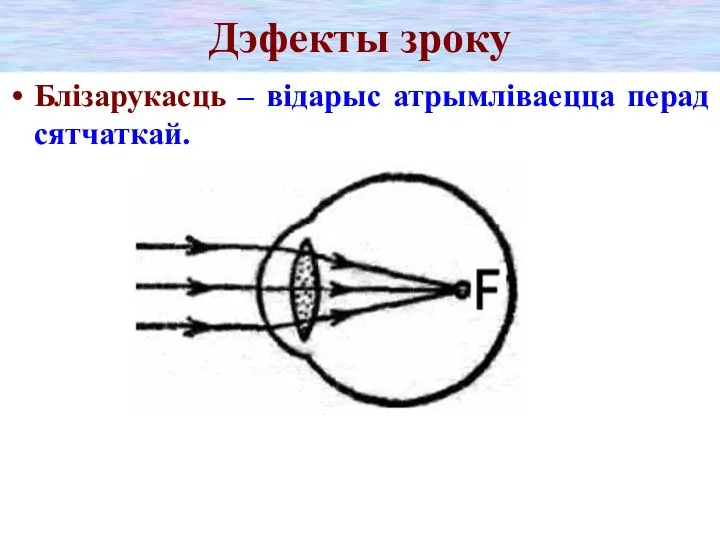 Дэфекты зроку Блізарукасць – відарыс атрымліваецца перад сятчаткай.