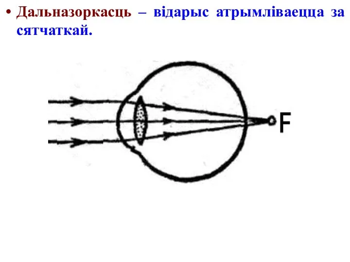 Дальназоркасць – відарыс атрымліваецца за сятчаткай.