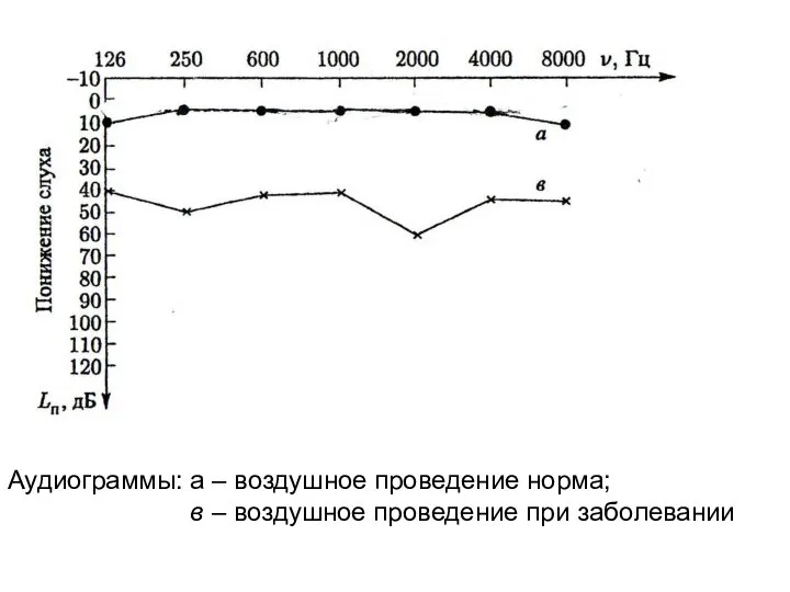 Аудиограммы: a – воздушное проведение норма; в – воздушное проведение при заболевании