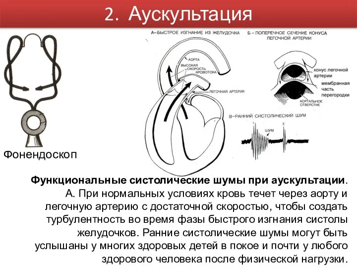 Фонендоскоп Функциональные систолические шумы при аускультации. А. При нормальных условиях кровь