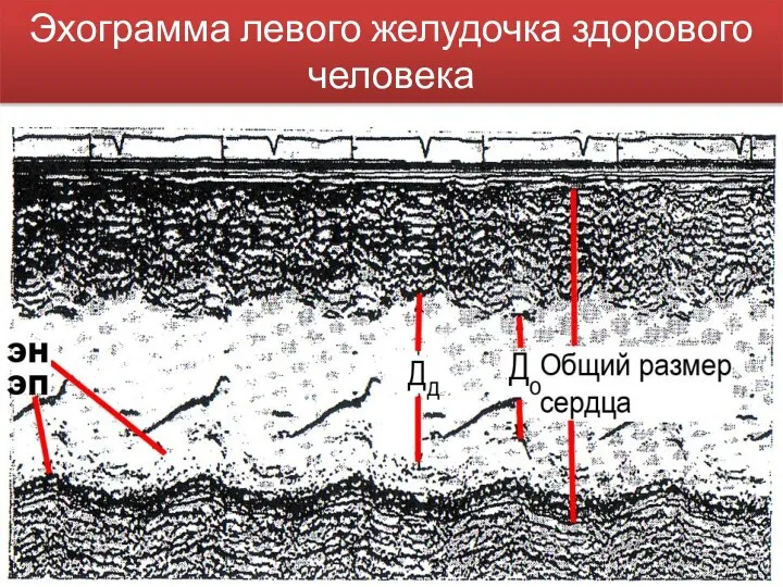 Эхограмма левого желудочка здорового человека