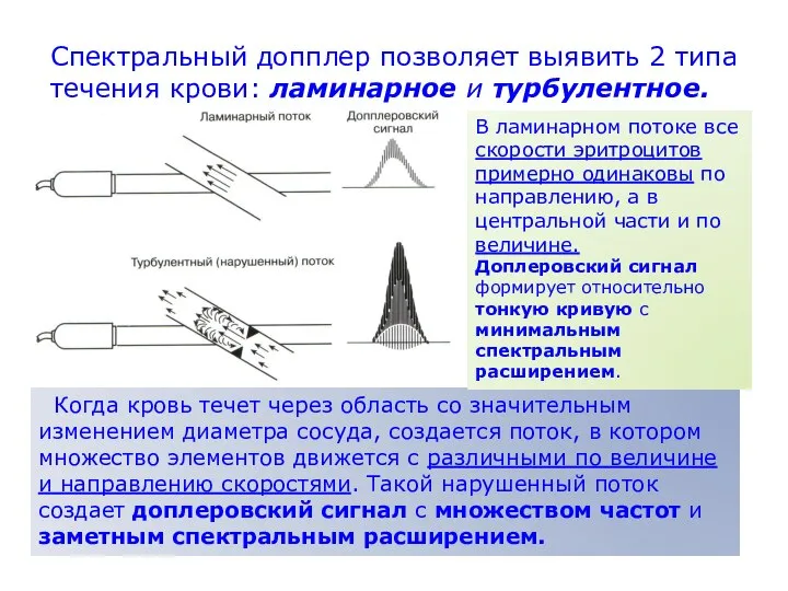 Спектральный допплер позволяет выявить 2 типа течения крови: ламинарное и турбулентное.