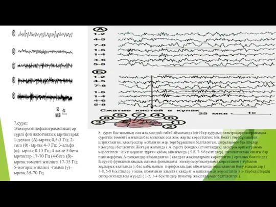 7.сурет Электроэнцефалограмманың әр түрлі физиологиялық ырғақтары: 1-дельта (Δ)-ырғақ 0,5-3 Гц; 2-тета