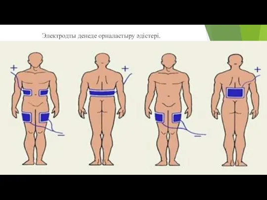 Электродты денеде орналастыру әдістері.