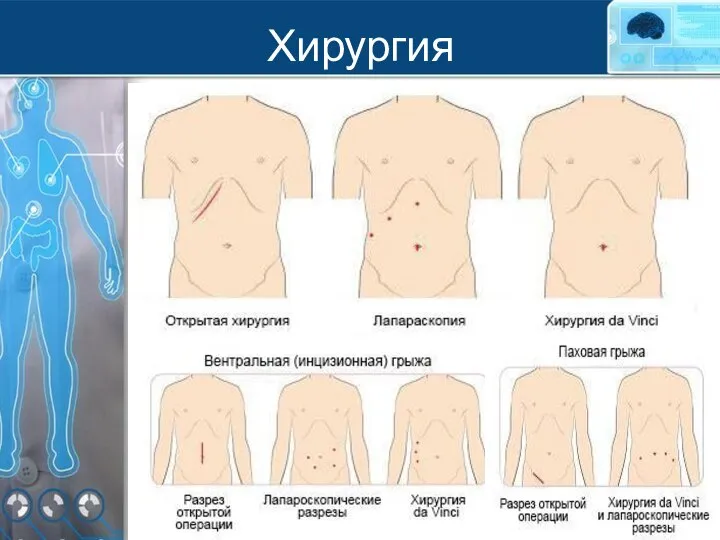 Хирургия бариатрическая хирургия миотомия по Геллеру холецистэктомия грыжа