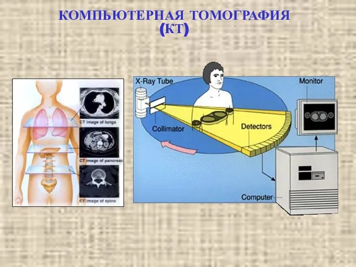 КОМПЬЮТЕРНАЯ ТОМОГРАФИЯ (КТ)