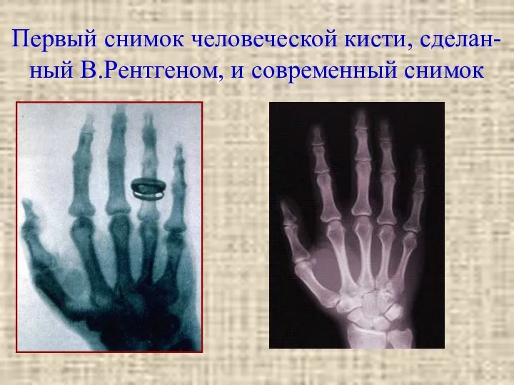 Первый снимок человеческой кисти, сделан- ный В.Рентгеном, и современный снимок