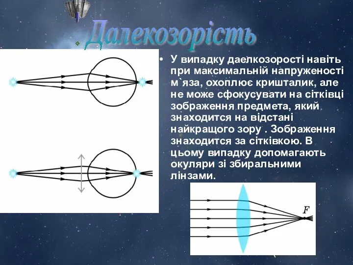 У випадку даелкозорості навіть при максимальній напруженості м`яза, охоплює кришталик, але