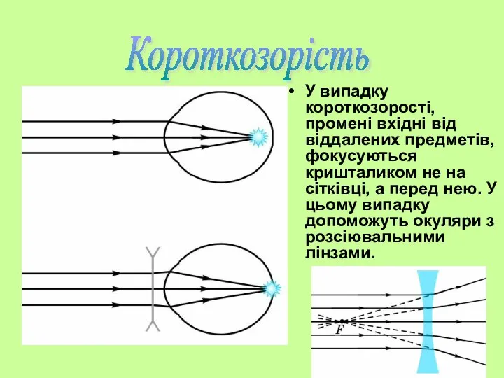 У випадку короткозорості, промені вхідні від віддалених предметів, фокусуються кришталиком не