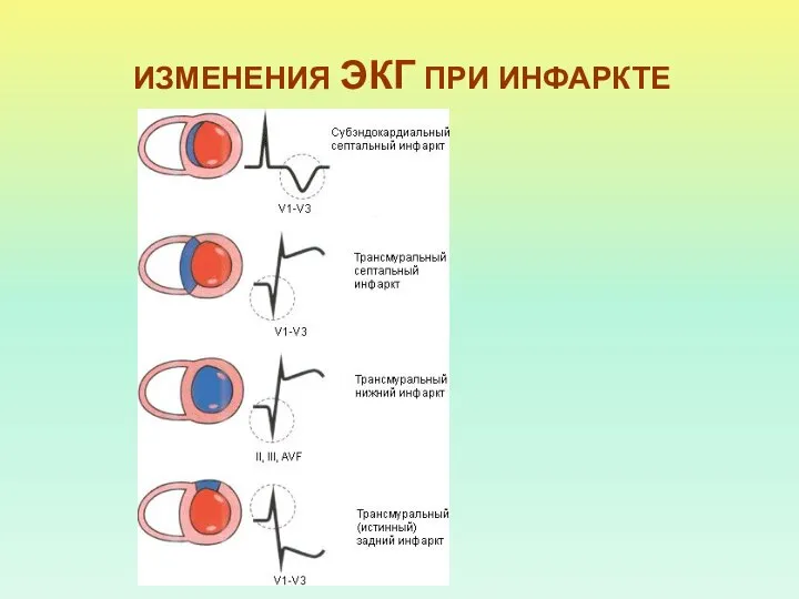 ИЗМЕНЕНИЯ ЭКГ ПРИ ИНФАРКТЕ