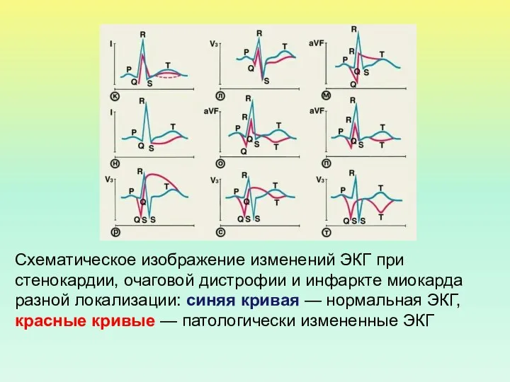 Схематическое изображение изменений ЭКГ при стенокардии, очаговой дистрофии и инфаркте миокарда