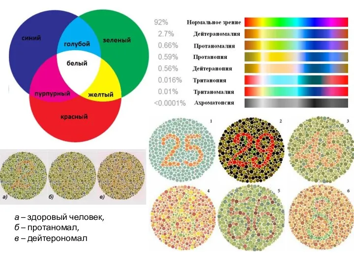 а – здоровый человек, б – протаномал, в – дейтерономал