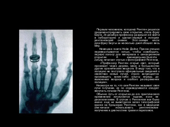 Первым человеком, которому Рентген решился продемонстрировать свое открытие, стала фрау Берта.