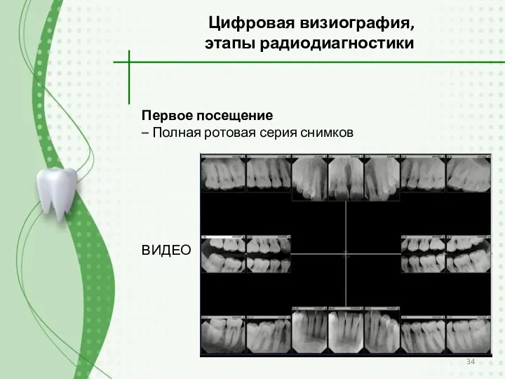 Цифровая визиография, этапы радиодиагностики Первое посещение – Полная ротовая серия снимков ВИДЕО