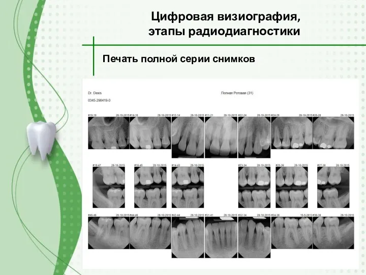 Цифровая визиография, этапы радиодиагностики Печать полной серии снимков