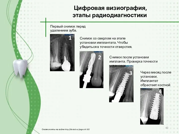 Первый снимок перед удалением зуба. Снимок со сверлом на этапе установки