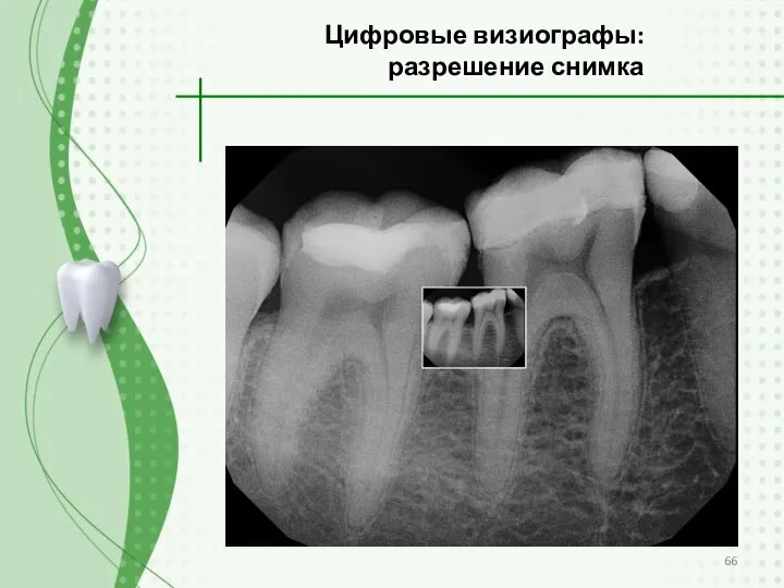 Цифровые визиографы: разрешение снимка