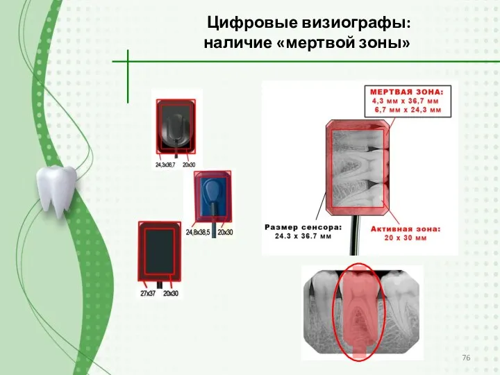 Цифровые визиографы: наличие «мертвой зоны»