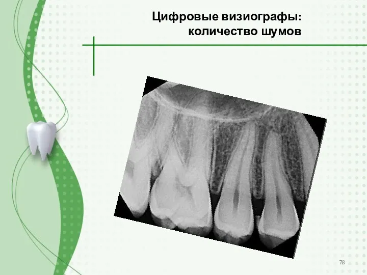 Цифровые визиографы: количество шумов