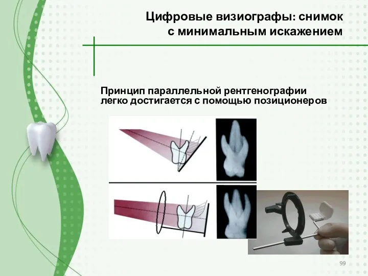 Принцип параллельной рентгенографии легко достигается с помощью позиционеров Цифровые визиографы: снимок с минимальным искажением