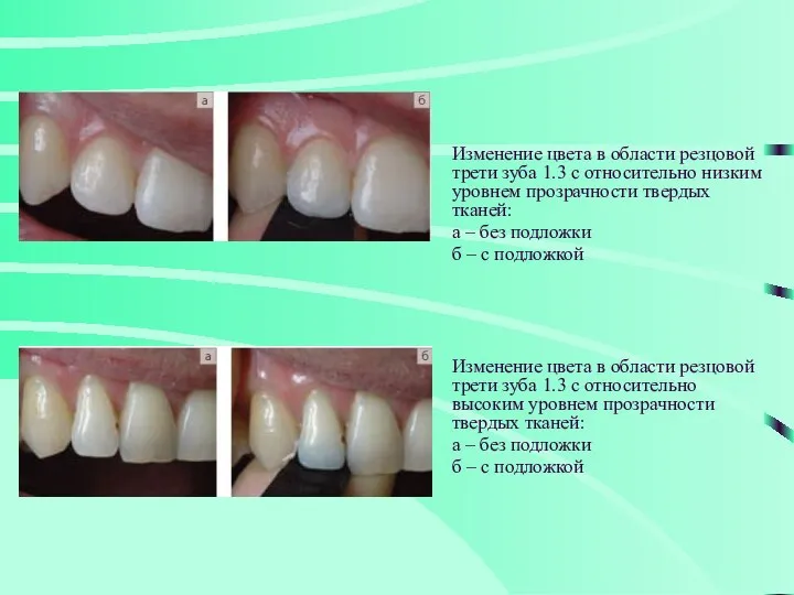 Изменение цвета в области резцовой трети зуба 1.3 с относительно низким