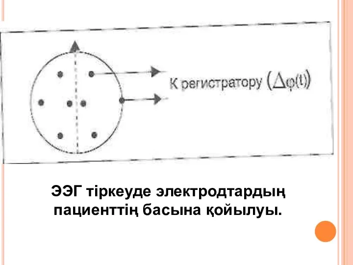 ЭЭГ тіркеуде электродтардың пациенттің басына қойылуы.