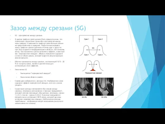 Зазор между срезами (SG) SG - пространство между срезами. В идеале