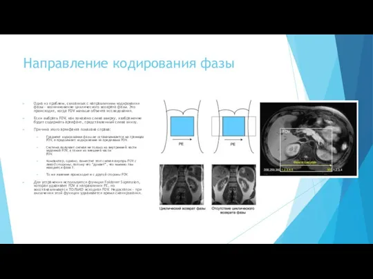 Направление кодирования фазы Одна из проблем, связанных с направлением кодирования фазы