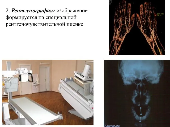 2. Рентгенография: изображение формируется на специальной рентгеночувствительной пленке