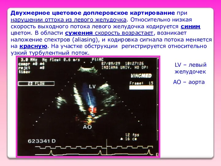 Двухмерное цветовое доплеровское картирование при нарушении оттока из левого желудочка. Относительно