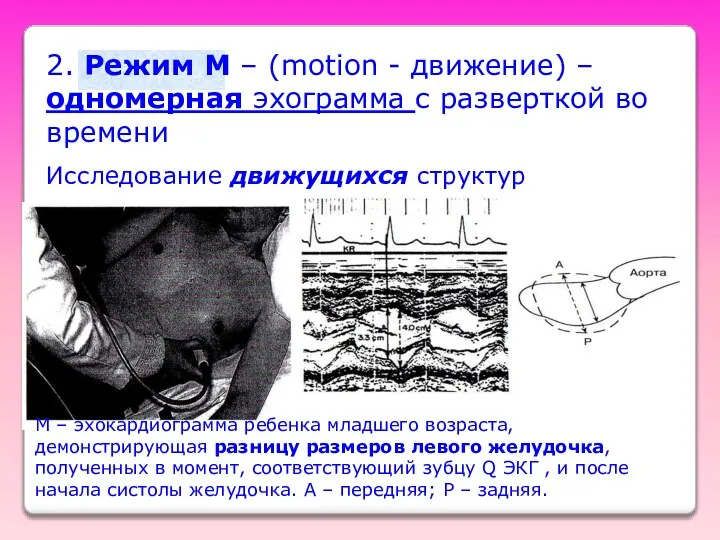 2. Режим M – (motion - движение) – одномерная эхограмма с