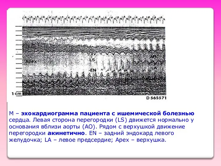 М – эхокардиограмма пациента с ишемической болезнью сердца. Левая сторона перегородки