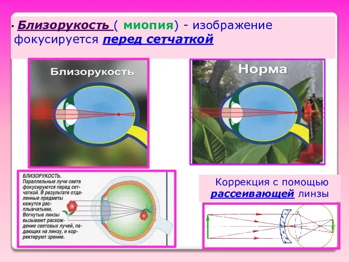 Близорукость ( миопия) - изображение фокусируется перед сетчаткой Коррекция с помощью рассеивающей линзы