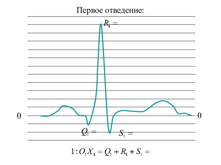 Первое отведение: