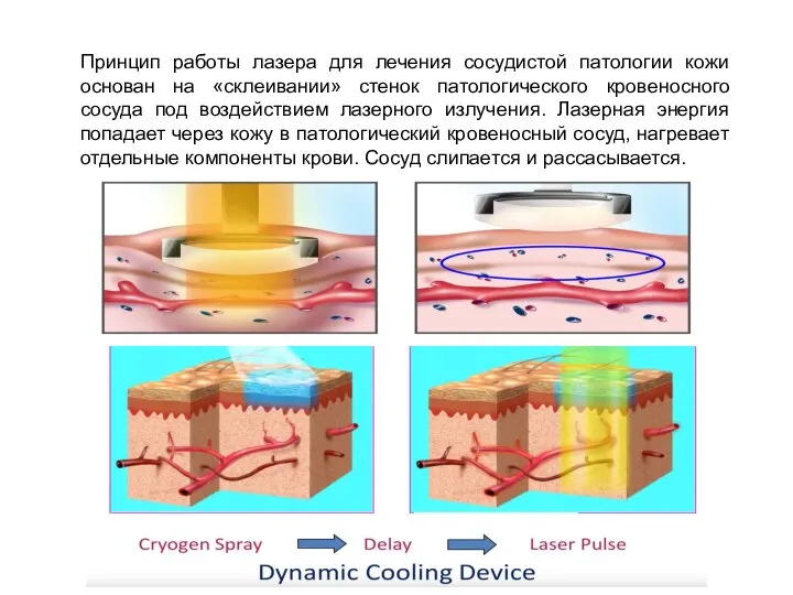 Принцип работы лазера для лечения сосудистой патологии кожи основан на «склеивании»