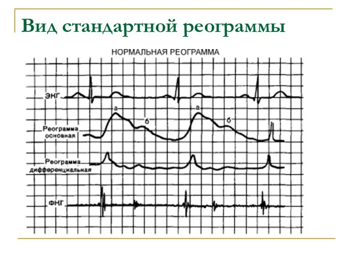 Вид стандартной реограммы