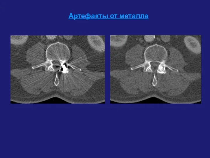 Артефакты от металла